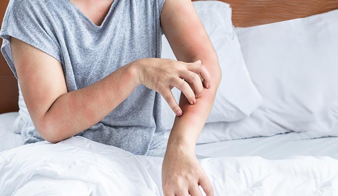 Person scratching rash on arm